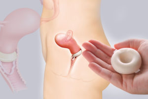 Миниатюра к статье Контрацептивная губка — особенности противозачаточного средства